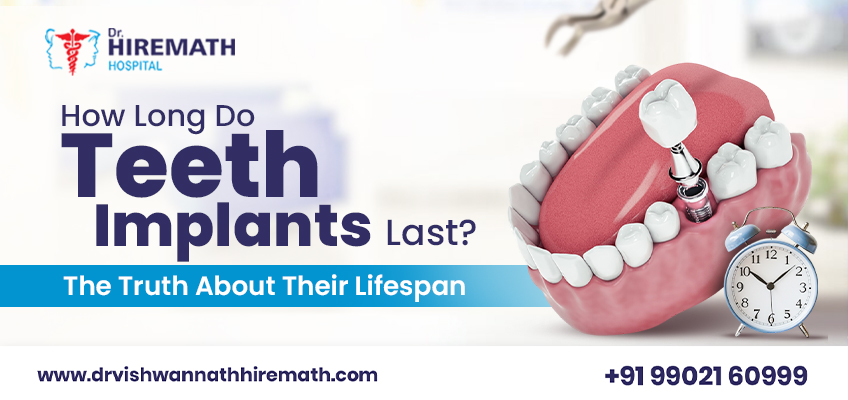 How-long-do-teeth-implants-last